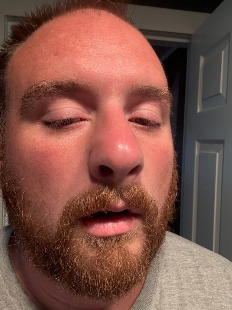 Very swollen face after defeated seltum surgery