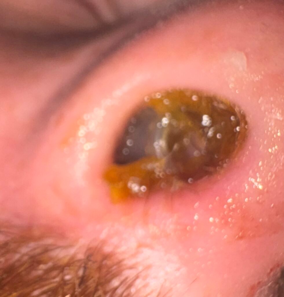 Clogged nose after septum surgery