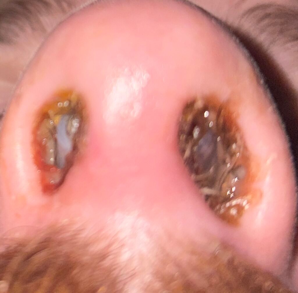 Nasty nose after sinus surgery