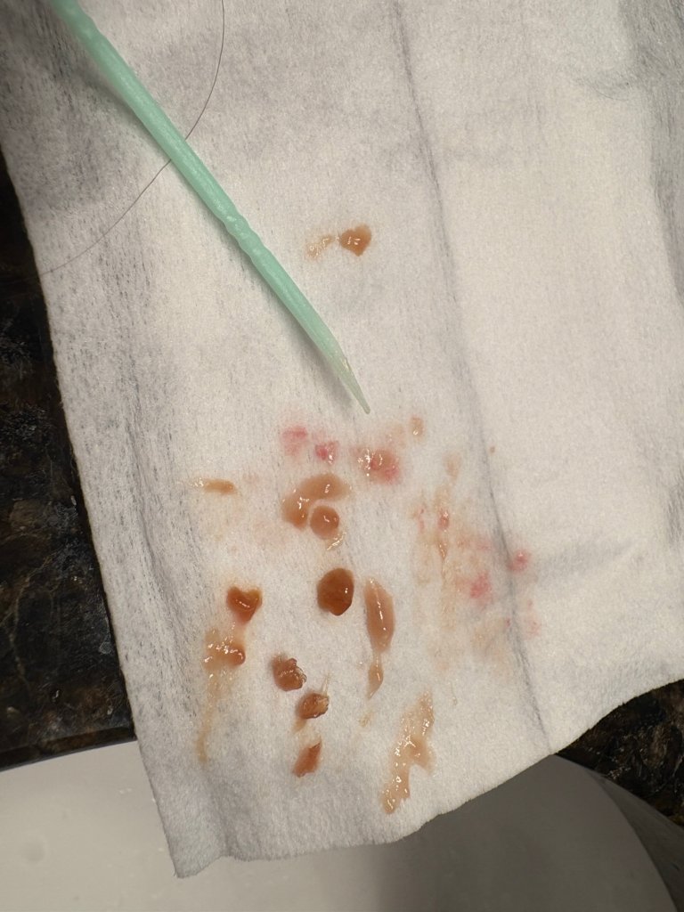 Dry boogers and drainage in nose after sinus surgery 