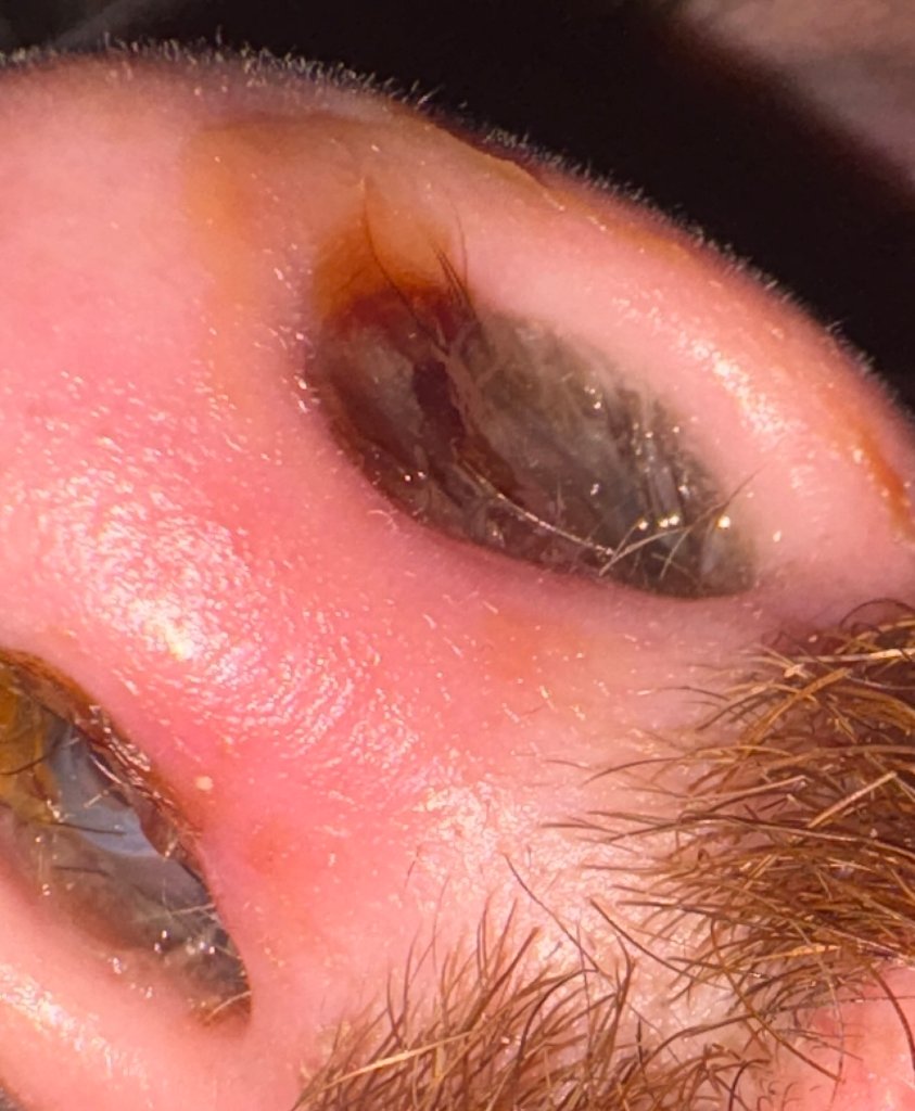 Clogged nose and crusting from sinoplasity surgery