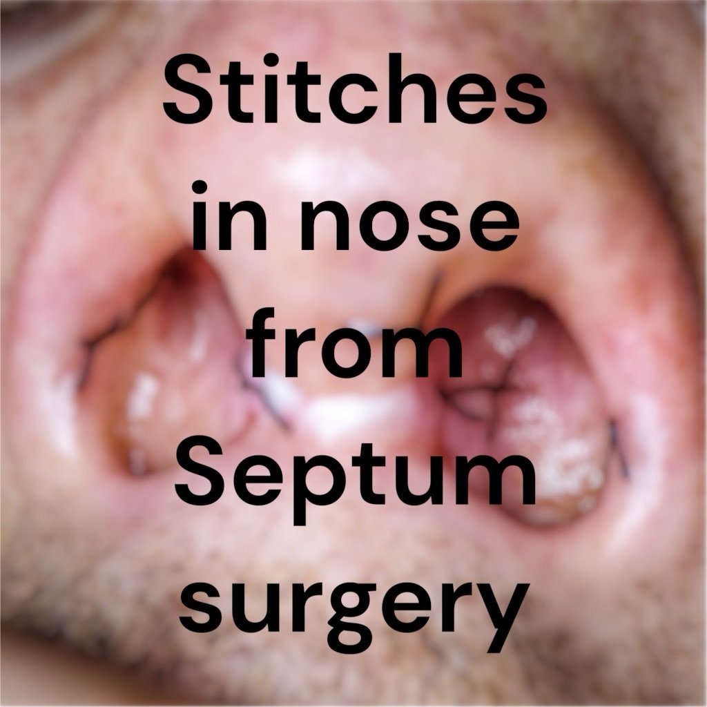 Stitches in nose from sinus surgery