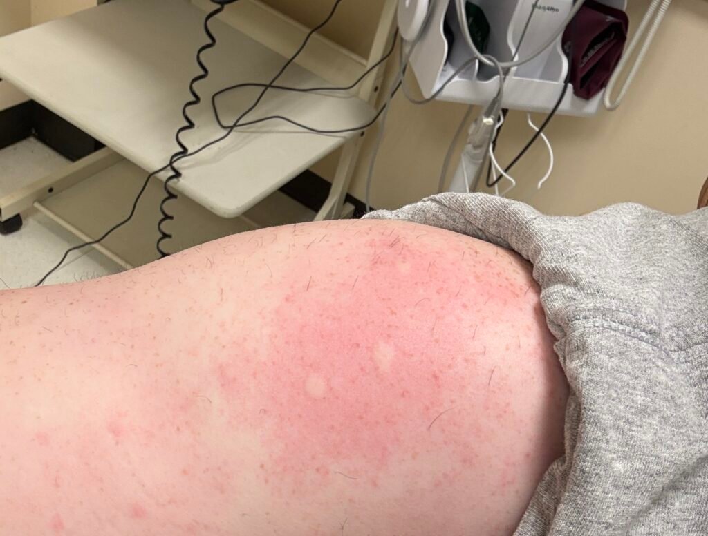 Positive reactions from my allergy test today! Tested positive for 9 of the 40 things tested! ​